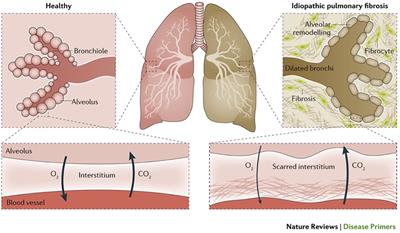 Interstitial lung disease: a review of classification, etiology, epidemiology, clinical diagnosis, pharmacological and non-pharmacological treatment